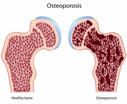remedio casero osteoporosis