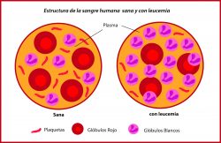 remedios-caseros-para-la-leucemia