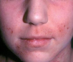 Remedios caseros para la dermatitis