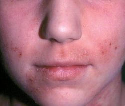 Remedios caseros para la dermatitis
