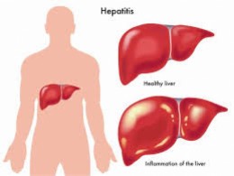 remedios caseros para la hepatitis