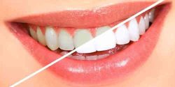 Remedios caseros para blanquear los dientes